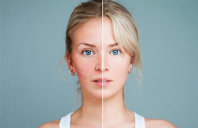 Rosacea Before & After