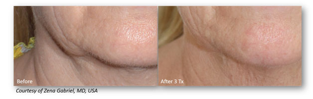 Neck-Jowls-1