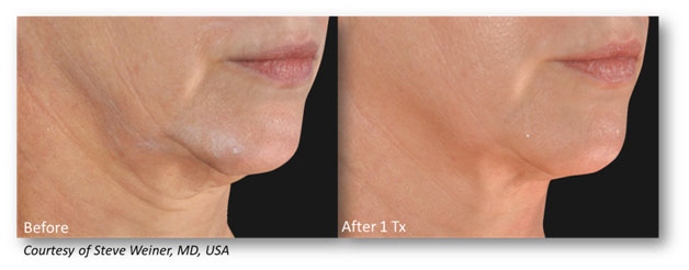 Neck-Jowls-2