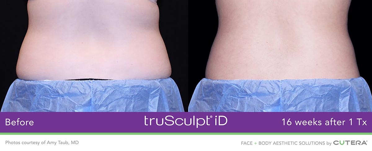 truSculpt-iD-Amy-Taub-MD-1